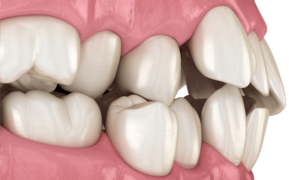 Illustration of misaligned teeth (malocclusion)